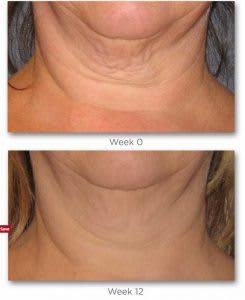 Neostrata neck cream